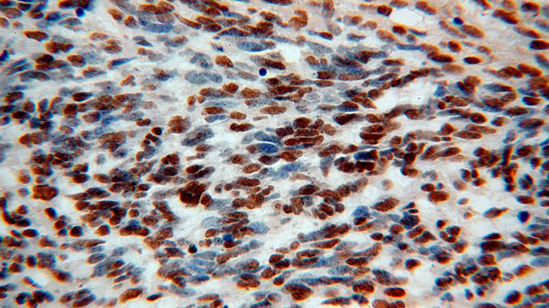 Immunohistochemical of paraffin-embedded human gliomas using Catalog No:115927(TARDBP antibody) at dilution of 1:100 (under 40x lens)