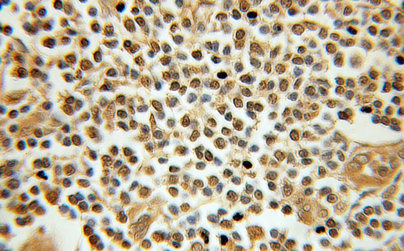 Immunohistochemical of paraffin-embedded human breast cancer using Catalog No:115991(TAF9B antibody) at dilution of 1:100 (under 10x lens)