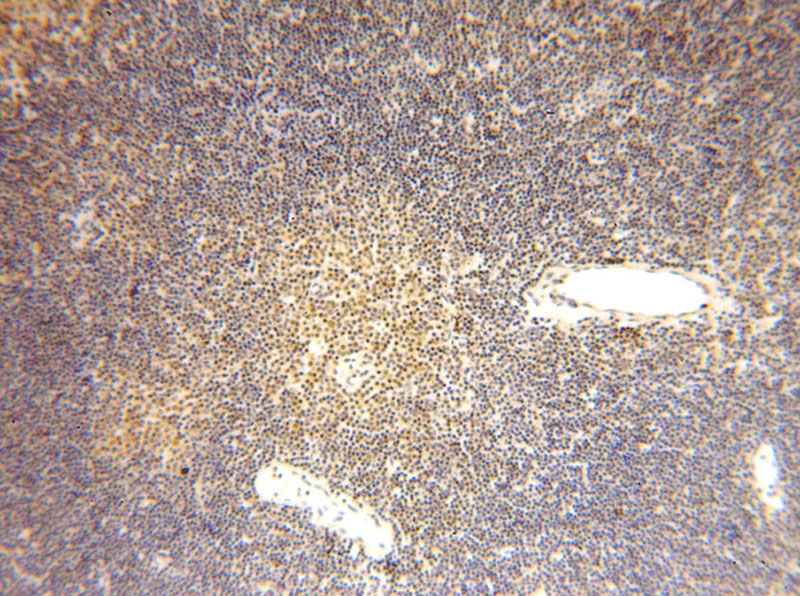 Immunohistochemical of paraffin-embedded human lymphoma using Catalog No:111096(GMDS antibody) at dilution of 1:50 (under 10x lens)