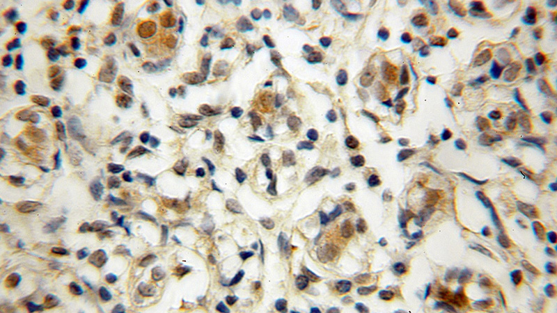 Immunohistochemical of paraffin-embedded human breast cancer using Catalog No:115691(STAT5A antibody) at dilution of 1:100 (under 10x lens)
