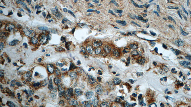 Immunohistochemistry of paraffin-embedded human stomach cancer tissue slide using Catalog No:116139(TIMP1 Antibody) at dilution of 1:50 (under 40x lens)