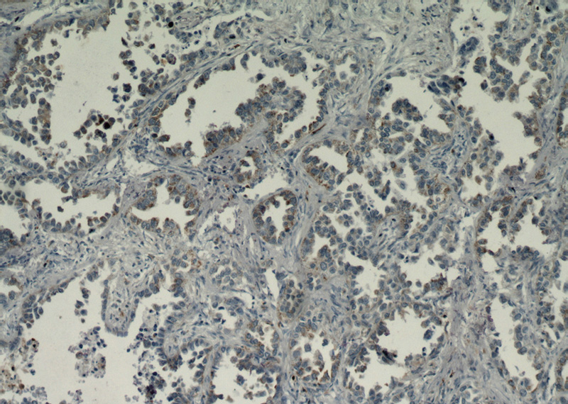 Immunohistochemical of paraffin-embedded human lung cancer using Catalog No:110467(FAM124B antibody) at dilution of 1:50 (under 10x lens). Heat mediated antigen retrieved with Citric acid buffer, pH6.0.