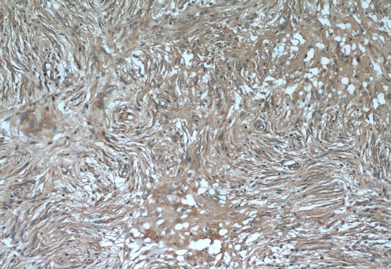 Immunohistochemistry of paraffin-embedded human meningioma tissue slide using Catalog No:117110(BCRP,ABCG2 Antibody) at dilution of 1:50 (under 10x lens)