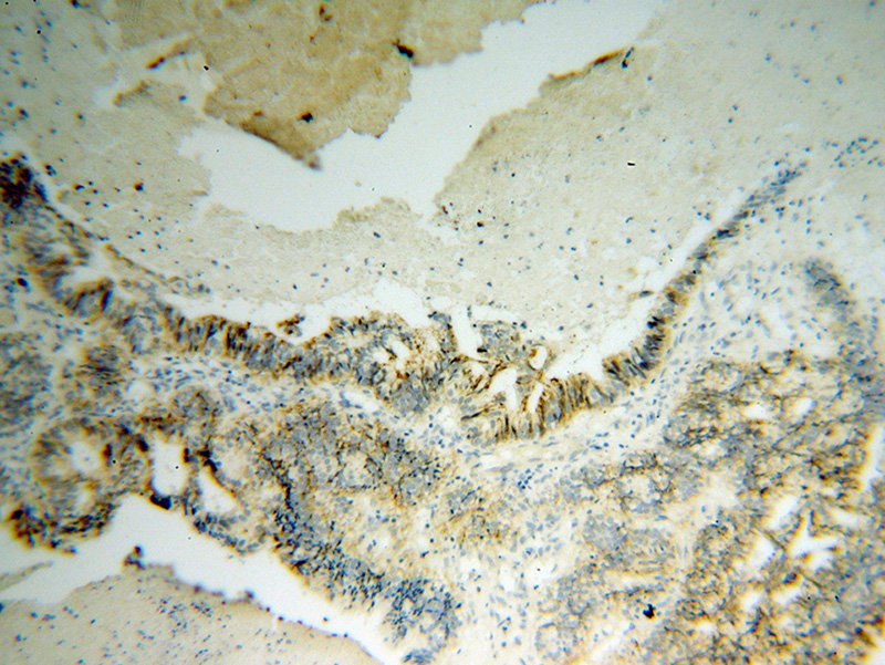 Immunohistochemical of paraffin-embedded human ovary tumor using Catalog No:109052(SDC1,CD138 antibody) at dilution of 1:100 (under 10x lens)