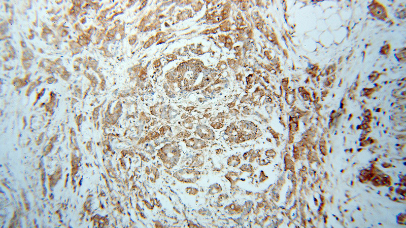 Immunohistochemical of paraffin-embedded human colon cancer using Catalog No:115655(SPTLC1 antibody) at dilution of 1:100 (under 10x lens)