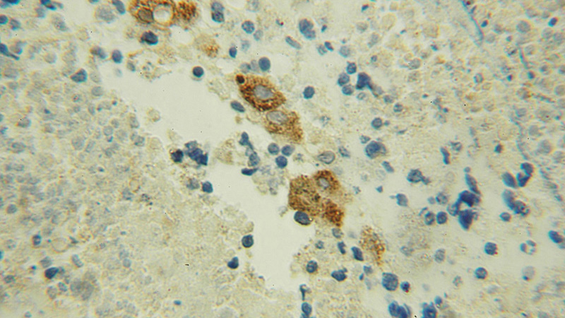 Immunohistochemical of paraffin-embedded human lung cancer using Catalog No:108892(CTSH antibody) at dilution of 1:50 (under 10x lens)