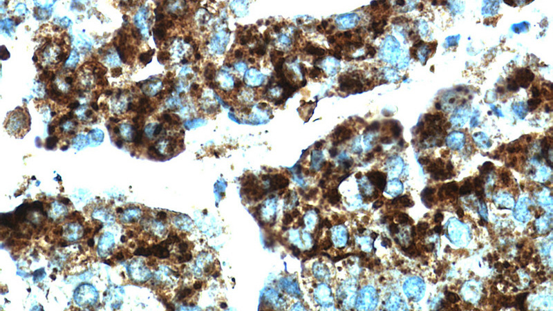 Immunohistochemical of paraffin-embedded human ovary tumor using Catalog No:109499(COX7A2L antibody) at dilution of 1:50 (under 40x lens)