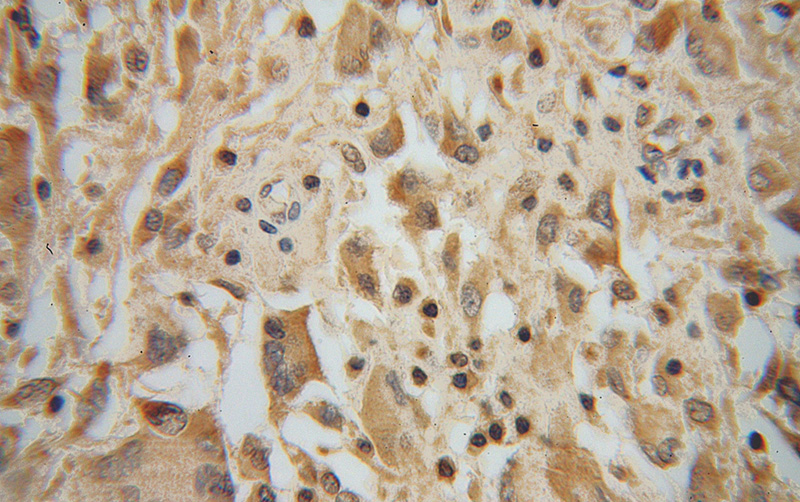 Immunohistochemical of paraffin-embedded human gliomas using Catalog No:114136(PPM1K antibody) at dilution of 1:50 (under 40x lens)