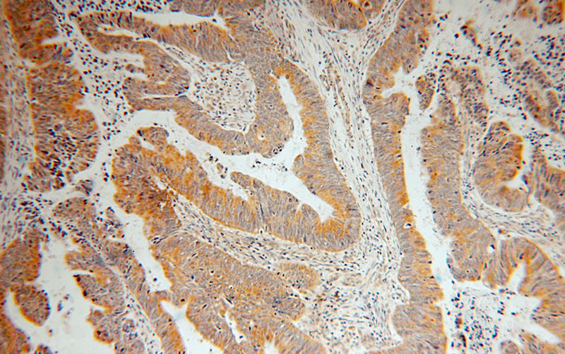 Immunohistochemical of paraffin-embedded human colon cancer using Catalog No:115066(SAR1B antibody) at dilution of 1:100 (under 10x lens)