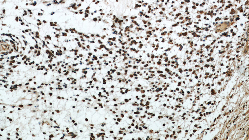 Immunohistochemical of paraffin-embedded human gliomas using Catalog No:112700(MMP2 antibody) at dilution of 1:50 (under 10x lens)