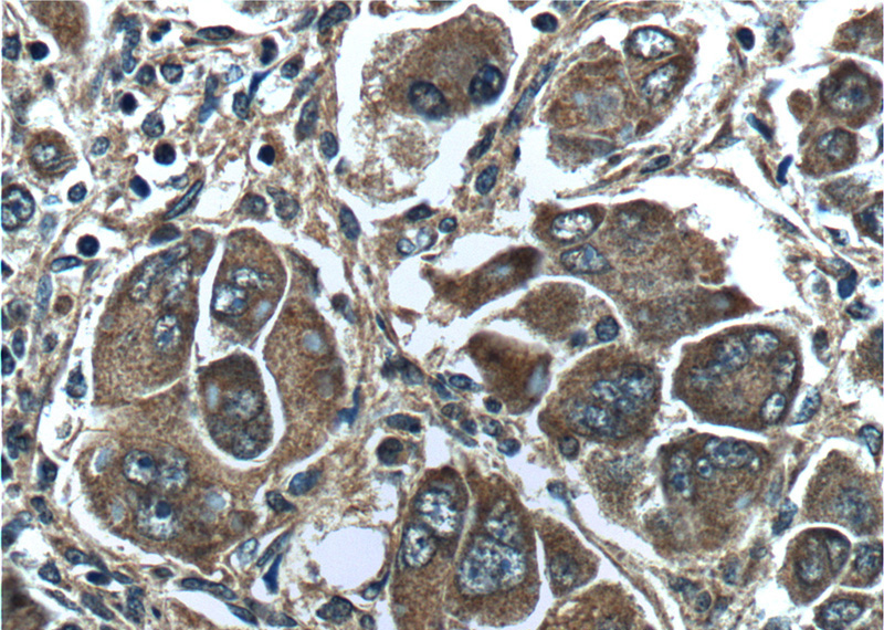 Immunohistochemistry of paraffin-embedded human liver cancer tissue slide using Catalog No:113491(PAH Antibody) at dilution of 1:200 (under 40x lens).