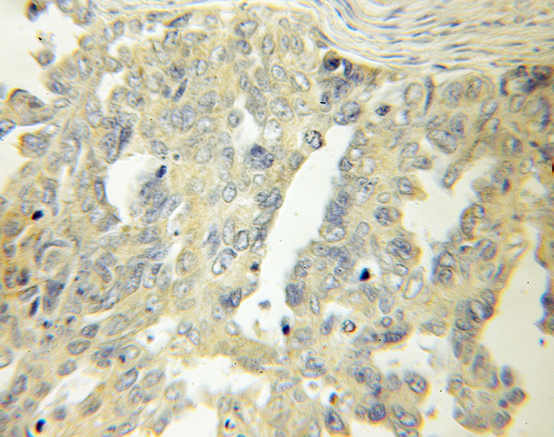 Immunohistochemical of paraffin-embedded human ovary tumor using Catalog No:112138(LAMR1,RPSA antibody) at dilution of 1:50 (under 10x lens)