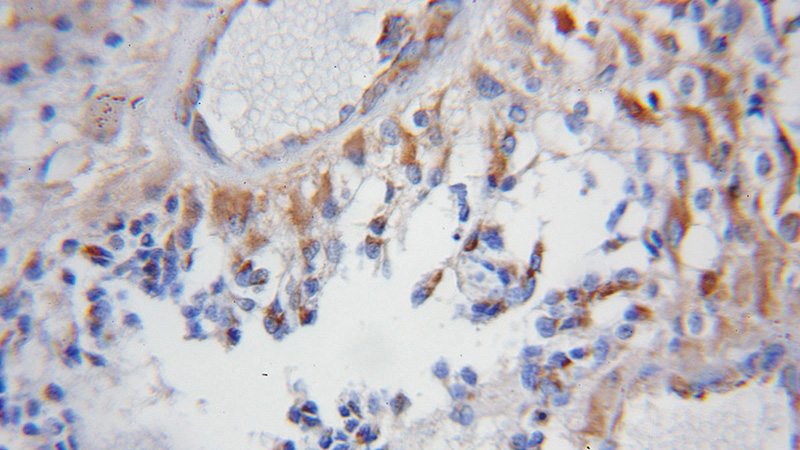 Immunohistochemical of paraffin-embedded human gliomas using Catalog No:109492(COX5B antibody) at dilution of 1:50 (under 10x lens)