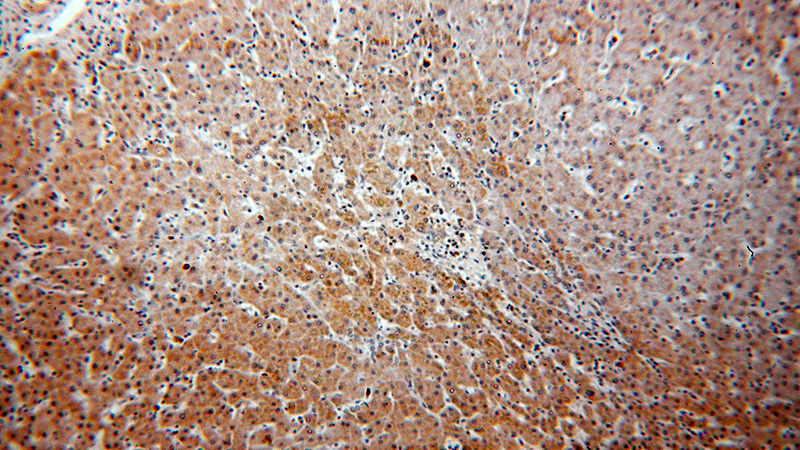 Immunohistochemical of paraffin-embedded human hepatocirrhosis using Catalog No:109706(CYP4F11-Specific antibody) at dilution of 1:50 (under 10x lens)