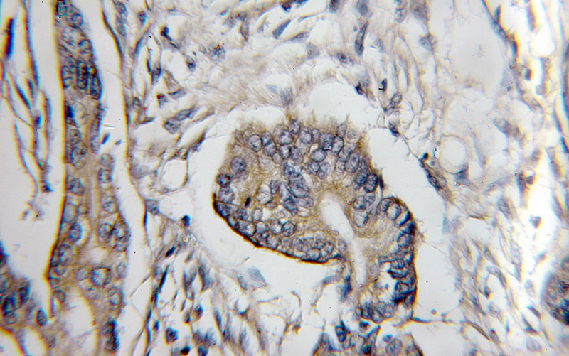 Immunohistochemical of paraffin-embedded human pancreas cancer using Catalog No:109496(COX6C antibody) at dilution of 1:50 (under 10x lens)