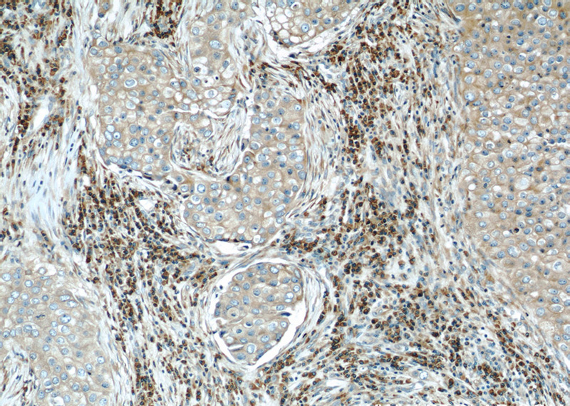Immunohistochemical of paraffin-embedded human breast cancer using Catalog No:116340(TRAPB, SSR2 antibody) at dilution of 1:50 (under 10x lens)