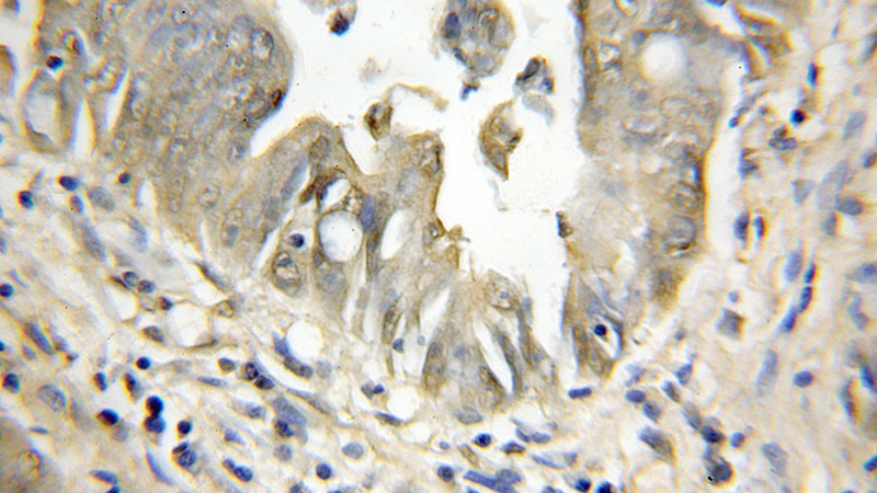Immunohistochemical of paraffin-embedded human colon cancer using Catalog No:113753(PCSK7 antibody) at dilution of 1:50 (under 10x lens)
