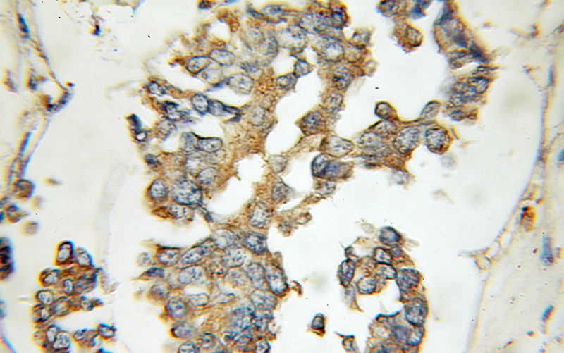 Immunohistochemical of paraffin-embedded human breast cancer using Catalog No:110184(EIF2B4 antibody) at dilution of 1:100 (under 10x lens)