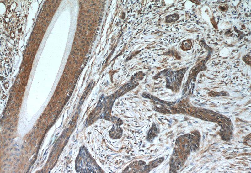 Immunohistochemistry of paraffin-embedded human skin cancer slide using Catalog No:107196(EXOSC2 Antibody) at dilution of 1:50