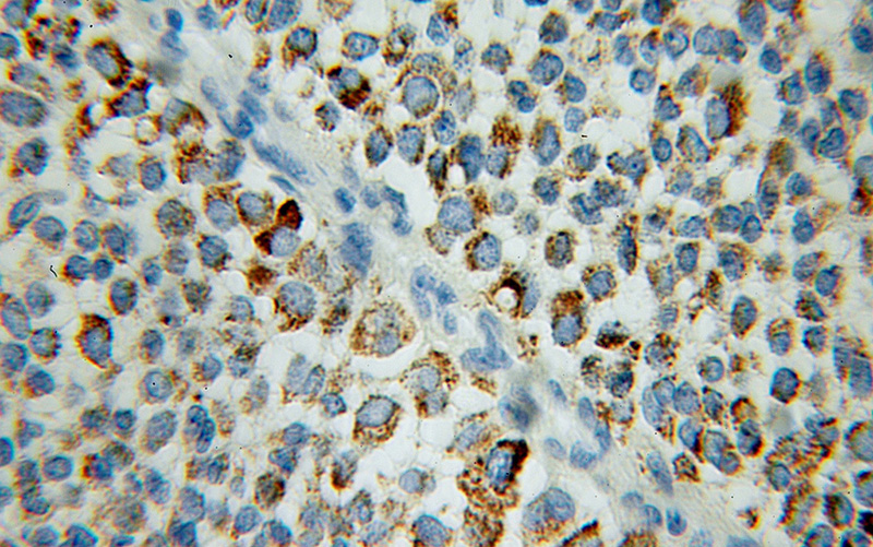Immunohistochemical of paraffin-embedded human breast cancer using Catalog No:107722(ACADSB antibody) at dilution of 1:100 (under 10x lens)