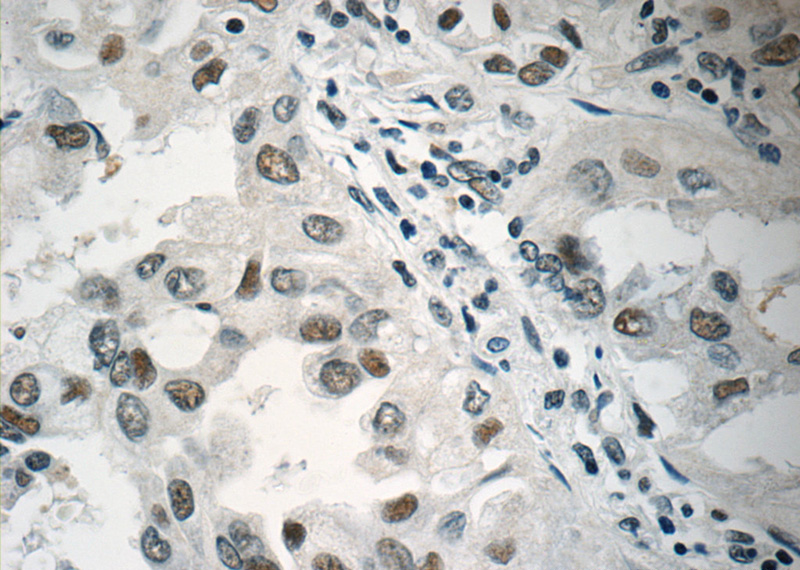Immunohistochemistry of paraffin-embedded human lung cancer tissue slide using Catalog No:113738(PCIF1 Antibody) at dilution of 1:50 (under 40x lens)