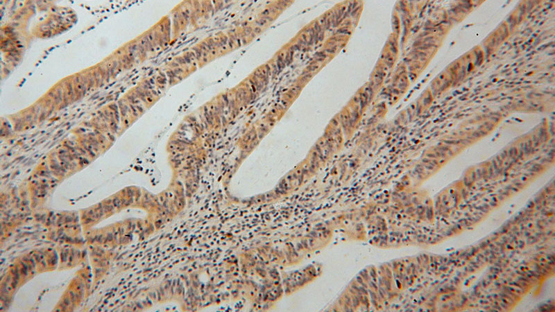 Immunohistochemical of paraffin-embedded human colon cancer using Catalog No:111103(GMPR antibody) at dilution of 1:100 (under 10x lens)