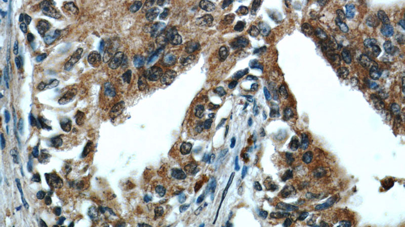 Immunohistochemistry of paraffin-embedded human prostate cancer tissue slide using Catalog No:107620(TFIP11 Antibody) at dilution of 1:50