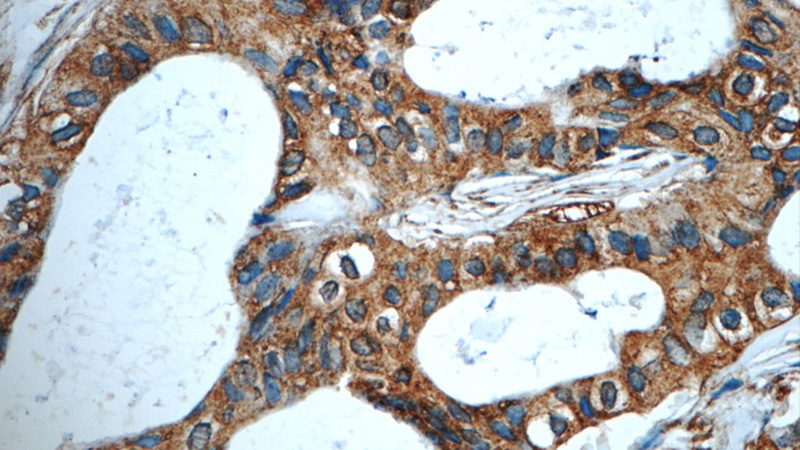Immunohistochemistry of paraffin-embedded human breast cancer tissue slide using Catalog No:107376(LGALS3BP Antibody) at dilution of 1:50 (under 40x lens)