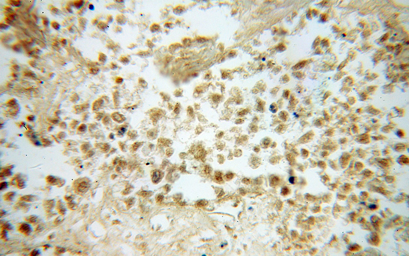 Immunohistochemical of paraffin-embedded human lung cancer using Catalog No:110750(FUT8 antibody) at dilution of 1:50 (under 40x lens)
