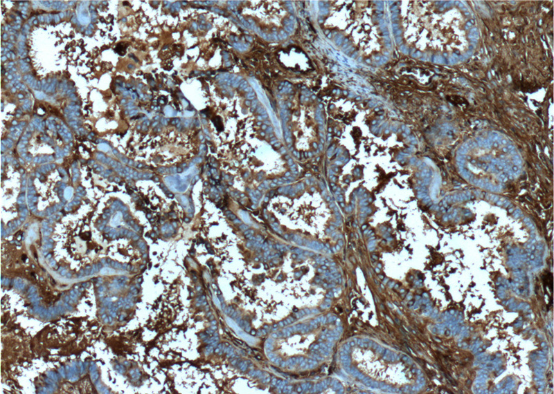 Immunohistochemistry of paraffin-embedded human ovary tumor tissue slide using Catalog No:107150(CP Antibody) at dilution of 1:200 (under 10x lens). heat mediated antigen retrieved with Tris-EDTA buffer(pH9).