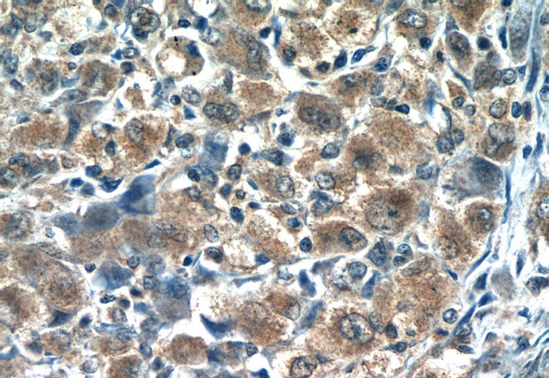 Immunohistochemistry of paraffin-embedded human lymphoma tissue slide using Catalog No:114738(RNF125 Antibody) at dilution of 1:50 (under 40x lens)
