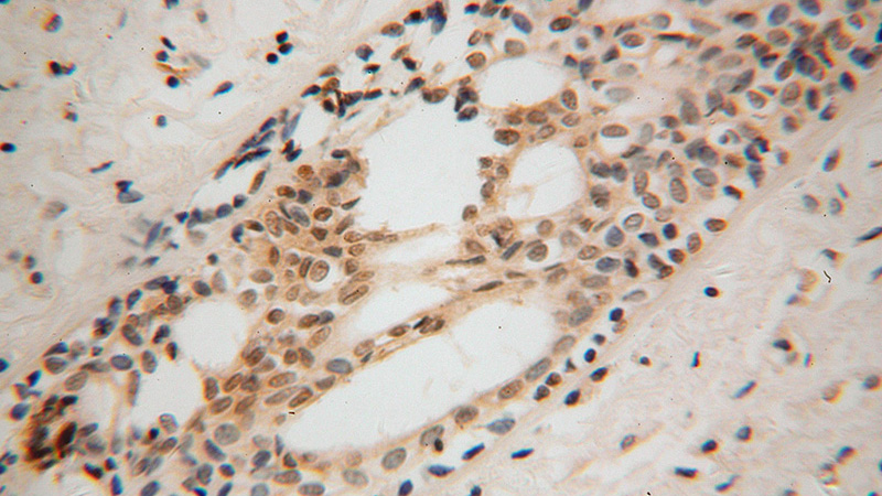 Immunohistochemical of paraffin-embedded human breast cancer using Catalog No:116000(TFAP2C antibody) at dilution of 1:100 (under 40x lens)
