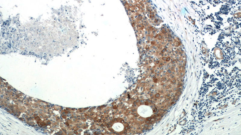 Immunohistochemistry of paraffin-embedded human breast cancer tissue slide using Catalog No:108904(CAST Antibody) at dilution of 1:50 (under 10x lens)