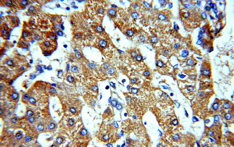 Immunohistochemical of paraffin-embedded human hepatocirrhosis using Catalog No:107714(ACTR10 antibody) at dilution of 1:100 (under 40x lens)
