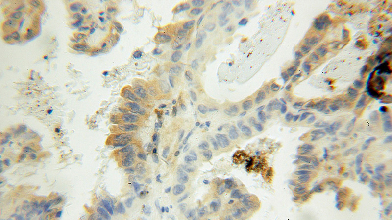 Immunohistochemical of paraffin-embedded human lung cancer using Catalog No:113734(PFDN2 antibody) at dilution of 1:100 (under 10x lens)