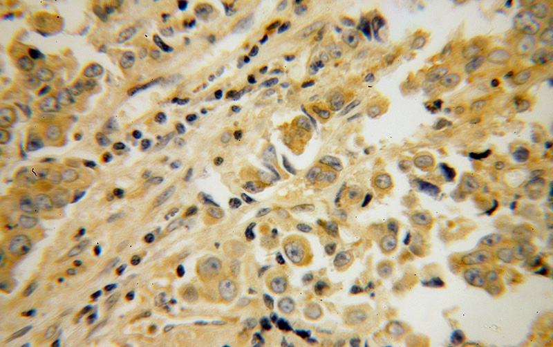 Immunohistochemical of paraffin-embedded human prostate cancer using Catalog No:114115(PPP3R2 antibody) at dilution of 1:50 (under 40x lens)