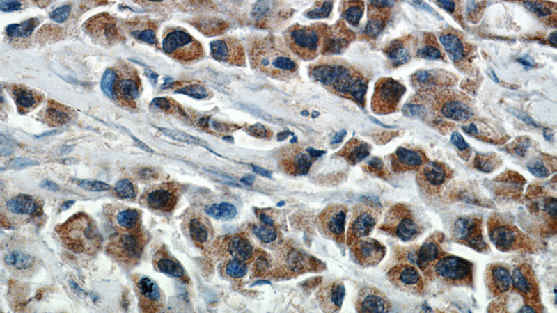 Immunohistochemical of paraffin-embedded human breast cancer using Catalog No:117262(ZP3 antibody) at dilution of 1:50 (under 40x lens)