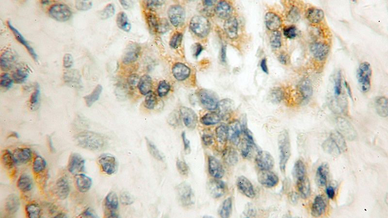 Immunohistochemical of paraffin-embedded human pancreas cancer using Catalog No:112326(PPIL5 antibody) at dilution of 1:50 (under 10x lens)