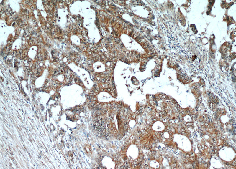 Immunohistochemical of paraffin-embedded human colon cancer using Catalog No:109244(CEACAM3-Specific antibody) at dilution of 1:50 (under 10x lens)
