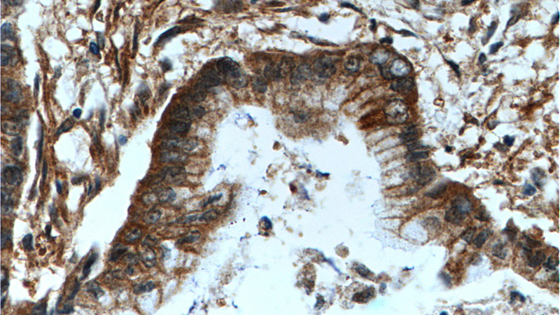 Immunohistochemistry of paraffin-embedded human pancreas cancer tissue slide using Catalog No:107762(ADAM17 Antibody) at dilution of 1:200 (under 40x lens).