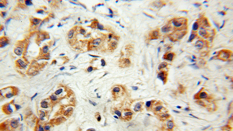 Immunohistochemical of paraffin-embedded human prostate cancer using Catalog No:114345(PVRL3, Nectin 3 antibody) at dilution of 1:100 (under 10x lens)