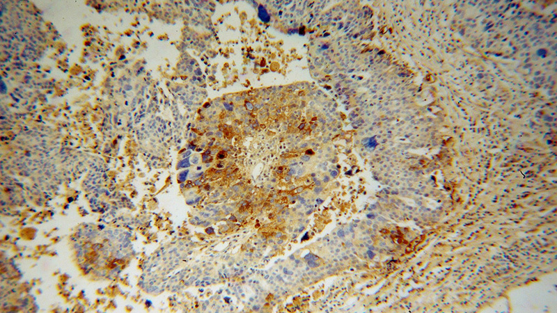 Immunohistochemical of paraffin-embedded human ovary tumor using Catalog No:113240(NLN antibody) at dilution of 1:50 (under 10x lens)