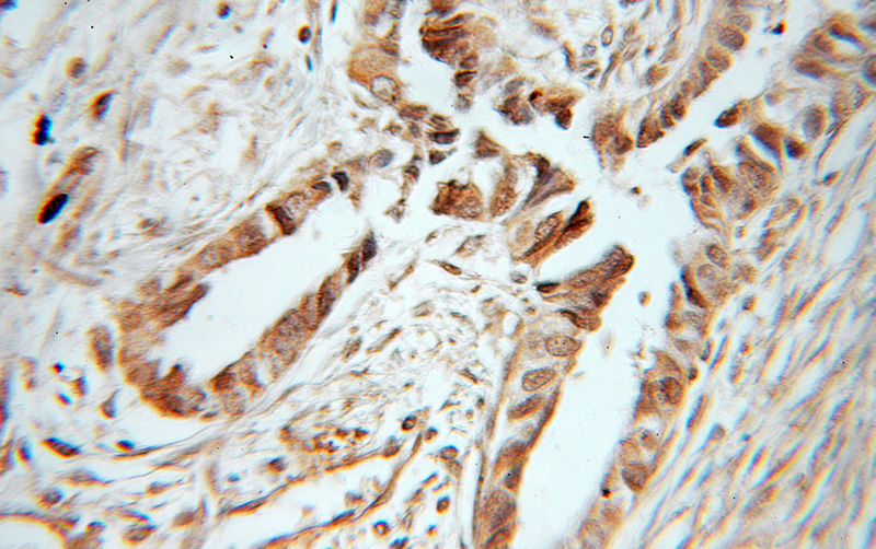 Immunohistochemical of paraffin-embedded human ovary tumor using Catalog No:117213(BORIS antibody) at dilution of 1:50 (under 40x lens)