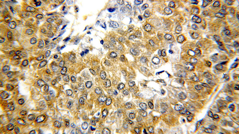 Immunohistochemical of paraffin-embedded human liver cancer using Catalog No:111570(HSP90 antibody) at dilution of 1:50 (under 40x lens)