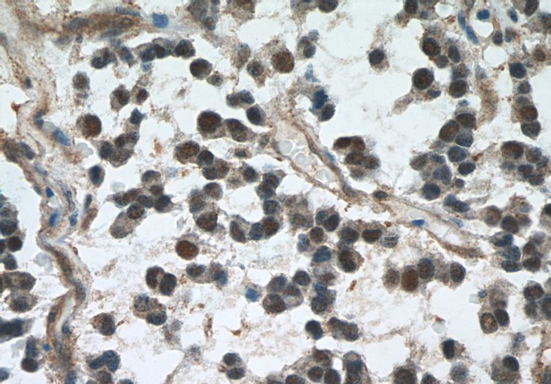 Immunohistochemistry of paraffin-embedded human gliomas tissue slide using Catalog No:107538(VCP Antibody) at dilution of 1:50 (under 40x lens)