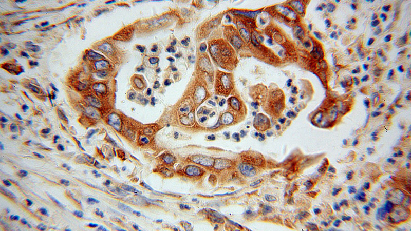 Immunohistochemical of paraffin-embedded human pancreas cancer using Catalog No:107249(EEF1D antibody) at dilution of 1:100 (under 40x lens)