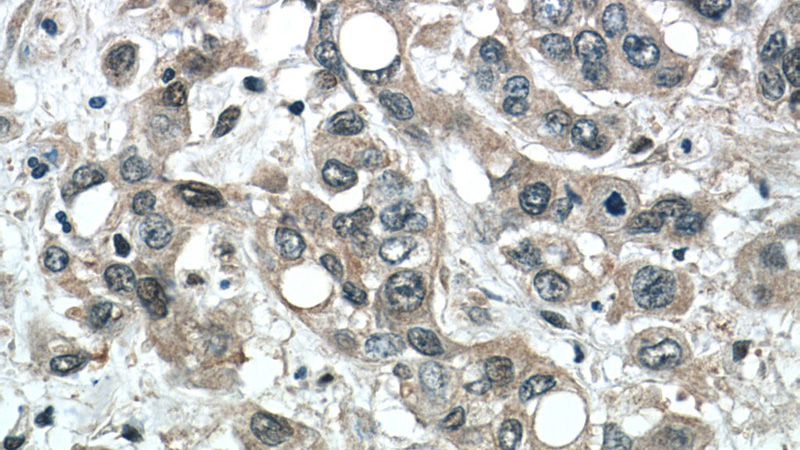 Immunohistochemistry of paraffin-embedded human stomach cancer tissue slide using Catalog No:115682(STARD8 Antibody) at dilution of 1:50 (under 40x lens)