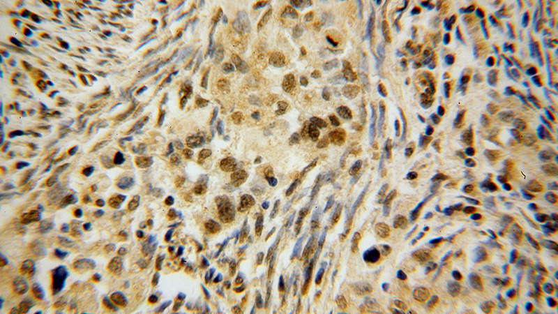 Immunohistochemical of paraffin-embedded human endometrial cancer using Catalog No:111435(HLX antibody) at dilution of 1:100 (under 40x lens)