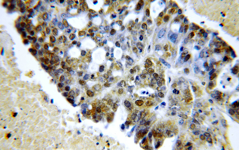 Immunohistochemical of paraffin-embedded human ovary tumor using Catalog No:115571(SPIN1 antibody) at dilution of 1:100 (under 40x lens)