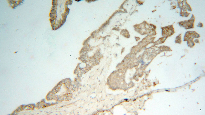 Immunohistochemical of paraffin-embedded human ovary tumor using Catalog No:116857(WDR18 antibody) at dilution of 1:100 (under 10x lens)